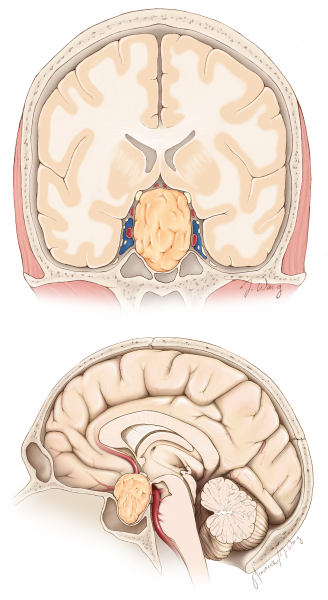 "كوشينغ": المرض الصامت الذي ينهك الجسد